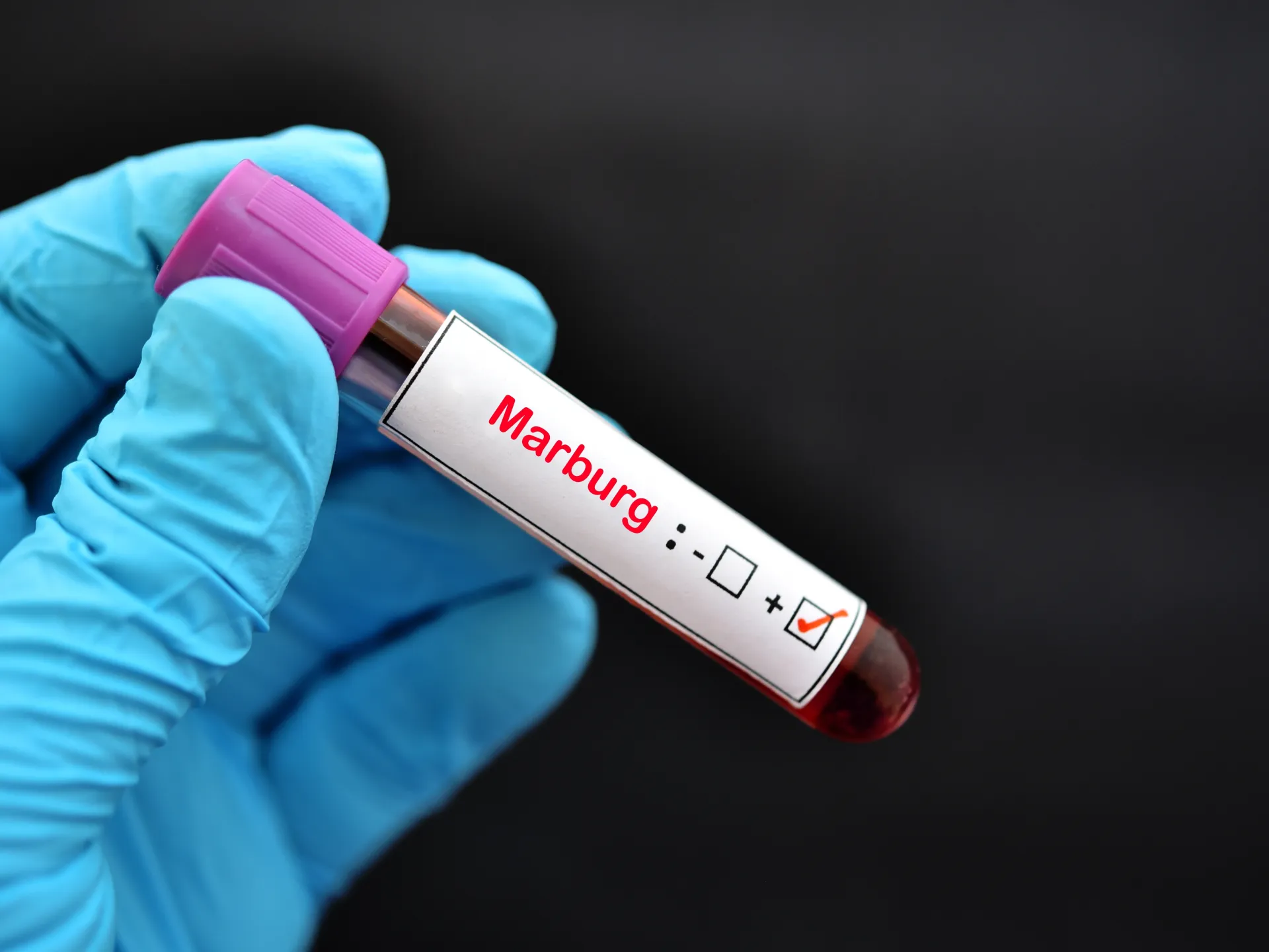 ما هو فيروس ماربورج؟.. تعرف على أعراضه وطرق الوقاية