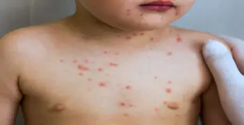 ينتمي فيروس الجدري إلى الفيروسات الارتجاعية.. صواب خطأ