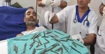 «قوة روحية طلبت ذلك».. إزالة 40 سكينا من معدة رجل بالهند
