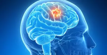 3 أعراض دليل على إصابتك بورم في الدماغ (فيديو)