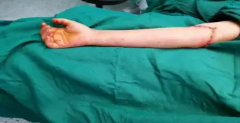 أستاذ بطب الأزهر يجري عملية لطفلة ويستعيد يدها المبتورة (صور)