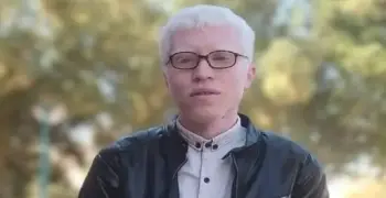 مصاب بالألبينو فمنعوا تعيينه.. التعليم العالي تتدخل بأزمة يوسف معيد سوهاج