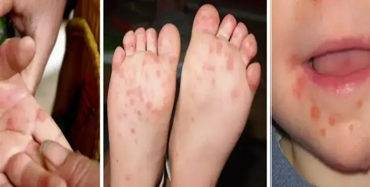  أعراض وطرق علاج مرض اليد والقدم والفم hfmd 
