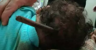 تكريم الفريق الطبي الذي أنقذ طفل رضيع اخترق «سيخ حديد» رأسه