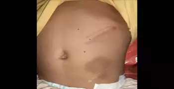 إخلاء سبيل المتهمة بتعذيب ابنة زوجها في القليوبية