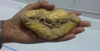 طبيب: الطحال «غير المؤدب» يجب استئصاله (فيديو)