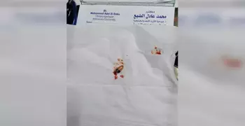 تدخل طبي لاستخراج سماعة من أذن طالب بالثانوية العامة في الدقهلية.. حاول الغش بها