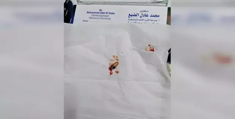  تدخل طبي لاستخراج سماعة من أذن طالب بالثانوية العامة في الدقهلية.. حاول الغش بها 