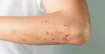 حقيقة غلق مدرسة في المنوفية بعد إصابة عدد من الطلاب بالجدري المائي