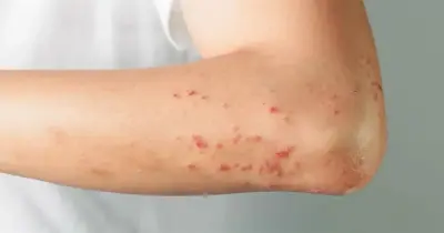 حقيقة غلق مدرسة في المنوفية بعد إصابة عدد من الطلاب بالجدري المائي