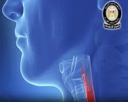 إنجاز طبي مصري: اعتماد «تقنية مدكور» لعلاج الأكالازيا دون جراحة