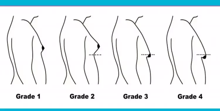  تمارين سهلة لعلاج مشكلة «التثدي» عند الرجال (فيديو) 