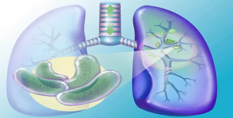  مرض السل.. الأسباب والوقاية والعلاج 