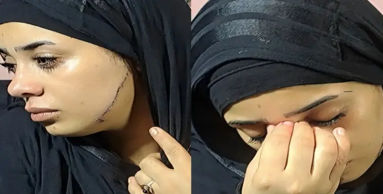  41 غرزة بوجه عروس مصر القديمة بسبب الغيرة.. فرحة ما تمت 