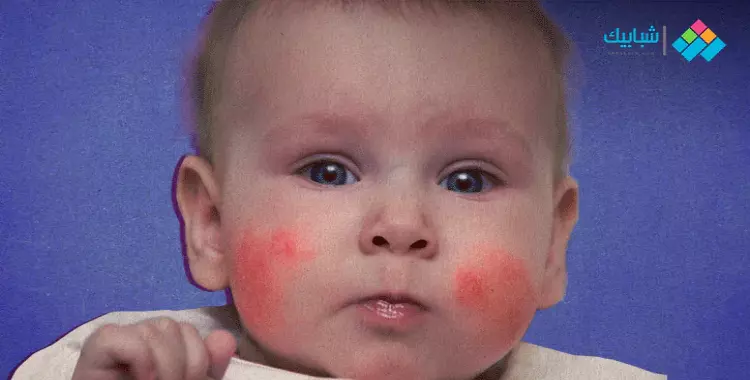  أعراض الحساسية عند الأطفال والرضع وكيفية السيطرة عليها 