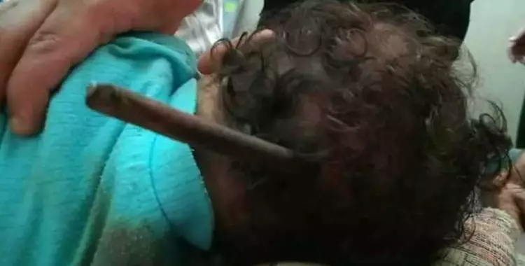  تكريم الفريق الطبي الذي أنقذ طفل رضيع اخترق «سيخ حديد» رأسه 